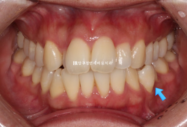 예비신부 교정 단기 앞니 부분교정 치료기간 6개월 관련 이미지 5