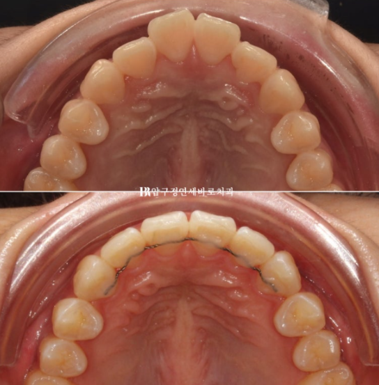 인비절라인 익스프레스 토끼이빨 교정 기간? 인비절라인 종류는? 관련 이미지 1