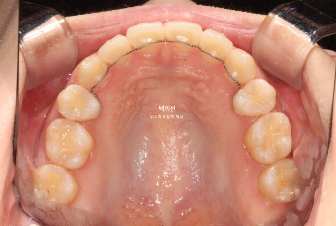 돌출입 교정 인비절라인 발치 교정 개방교합 치료 후기 관련 이미지 20