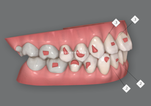 인비절라인 익스프레스 토끼이빨 교정 기간? 인비절라인 종류는? 관련 이미지 5