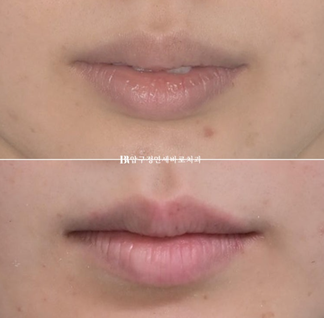 Gummy Smile Correction, Gummy Smile Orthodontics, Rabbit Teeth Correction image 15