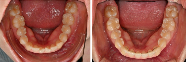 덧니 인비절라인 라이트 잇몸미소 거미스마일 중심선 블랙트라이앵글 관련 이미지 15
