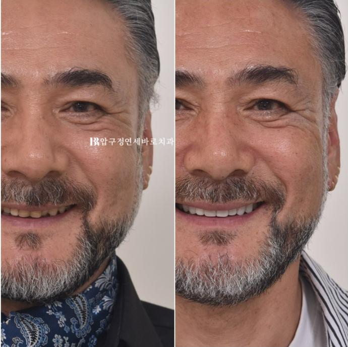 50대 중년교정 무삭제 라미네이트 중년 부분교정 후기 관련 이미지 1
