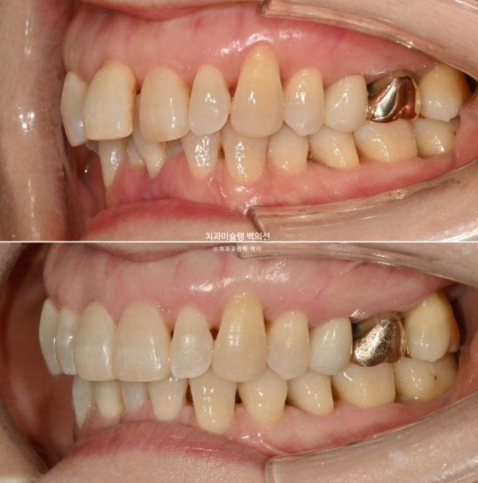 50대 치아교정 중년 발치교정 블랙트라이앵글 치료 후기 관련 이미지 18