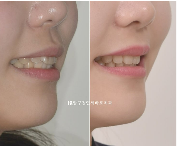 인비절라인 돌출입 발치교정, 정말 결과가 안 좋을까요? 관련 이미지 16