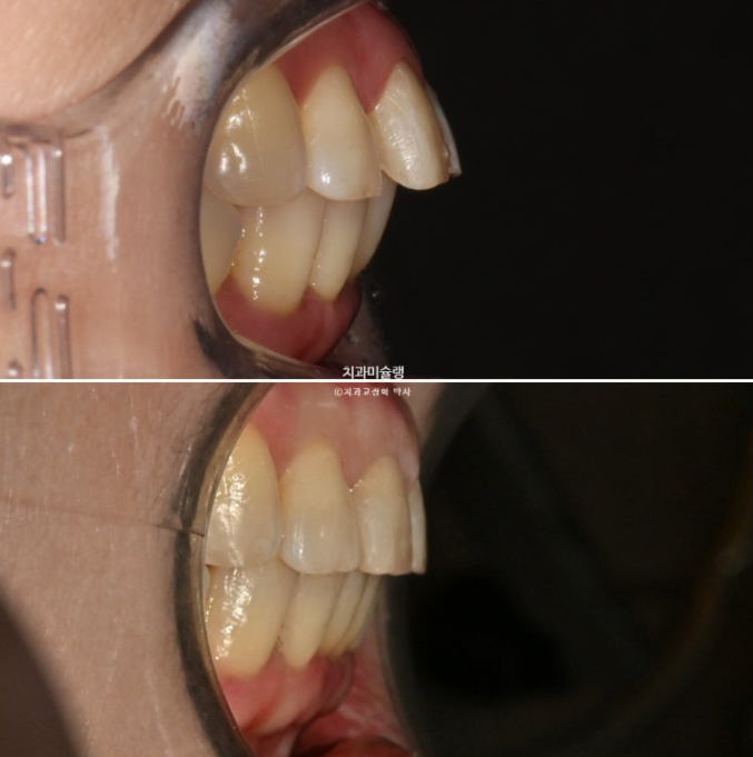 50대 치아교정 돌출 치아벌어짐 중년교정 관련 이미지 18