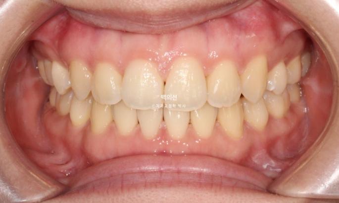 돌출입 교정 인비절라인 발치 교정 개방교합 치료 후기 관련 이미지 18