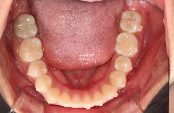 유학생 치아교정 해외거주 한국에서 치아교정? 관련 이미지 12