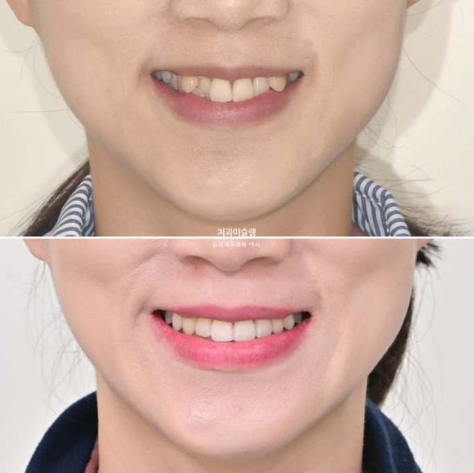 인비절라인 비발치 제2대구치 발치 사랑니 대체 교정 심한 덧니 교정 치료 관련 이미지 1