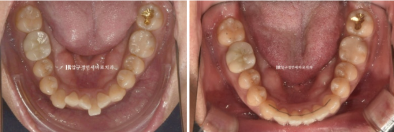 40대 중년 치아교정 인비절라인 라이트 치료기간 8개월 관련 이미지 13