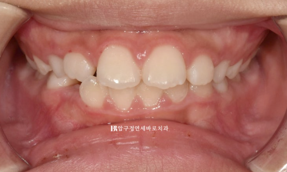 A Child’s Protruding Teeth Correction Review: Difficulty Closing the Lips image 2