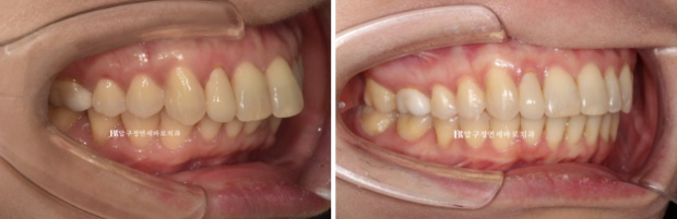 40대 인비절라인 라이트 가위교합? 관련 이미지 14