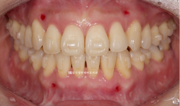 Is Invisalign Treatment Possible After Double-Jaw Surgery? A Real One-Year Case of Surgery-First Orthodontic Treatment image 6