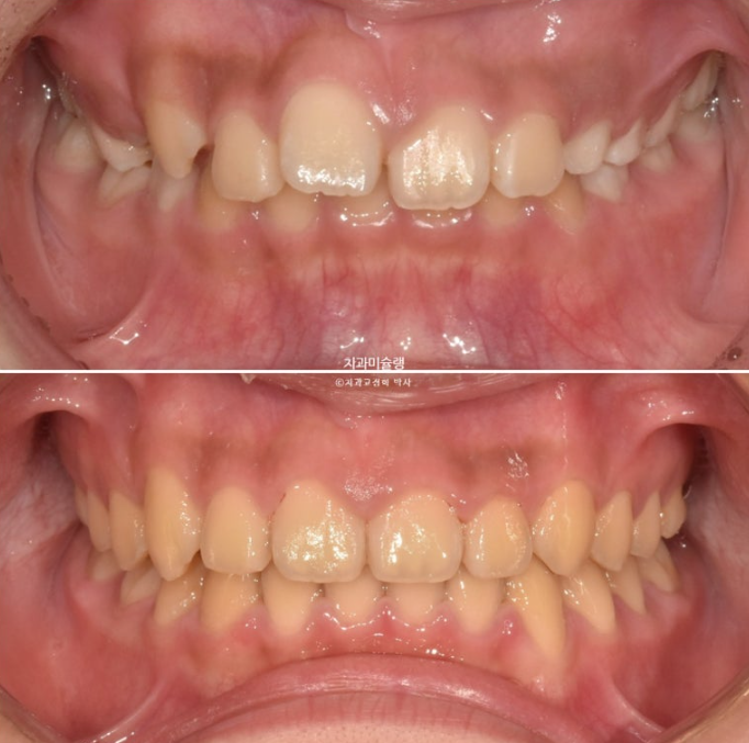선천적 결손 잔존유치 과개교합 돌출입 인비절라인 퍼스트 어린이 투명교정 치료기간 관련 이미지 19