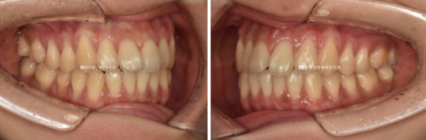 인비절라인 익스프레스 토끼이빨 교정 기간? 인비절라인 종류는? 관련 이미지 4