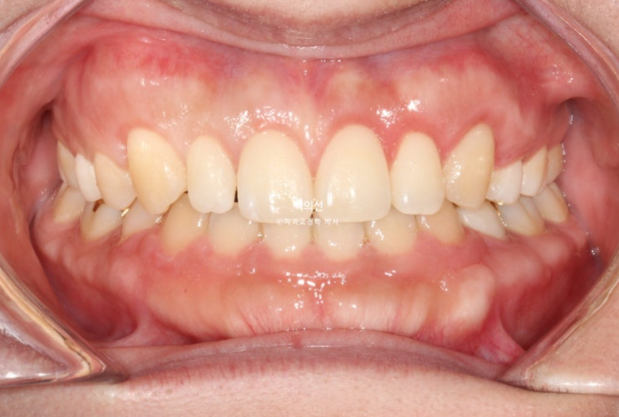 30대 치아교정 돌출입 교정 :: 잇몸미소 거미스마일 교정 입술부전증 결손치 무턱교정 관련 이미지 12