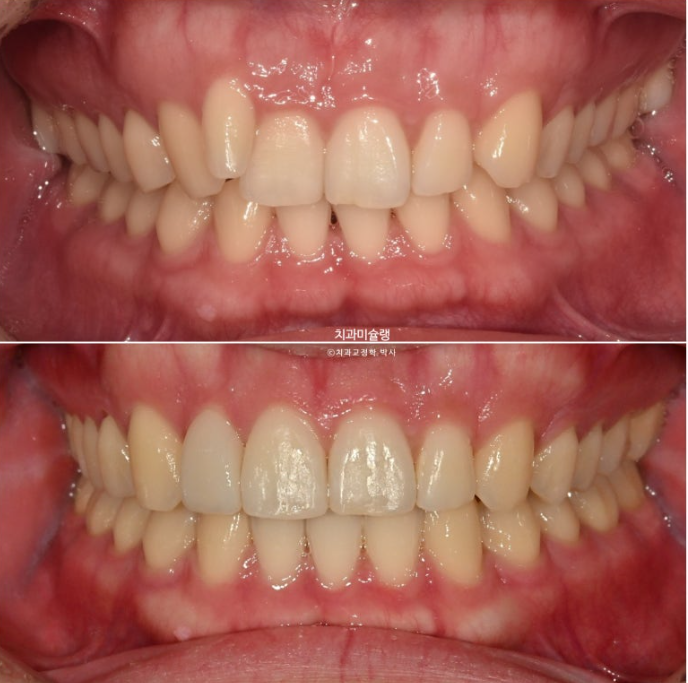 옥니 덧니 교정 왜소치 선천적 결손 3전치 무삭제 라미네이트 인비절라인 교정 관련 이미지 19