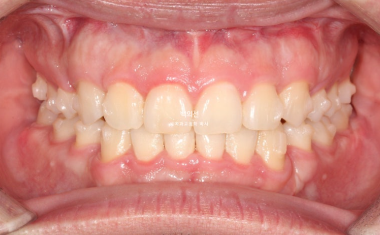 돌출입 수술 ASO + 인비절라인 라이트 후교정 치료기간 10개월 관련 이미지 8