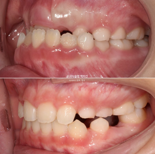 어린이 비대칭 반대교합 주걱턱 인비절라인 퍼스트 프리올소 성장 교정 관련 이미지 26