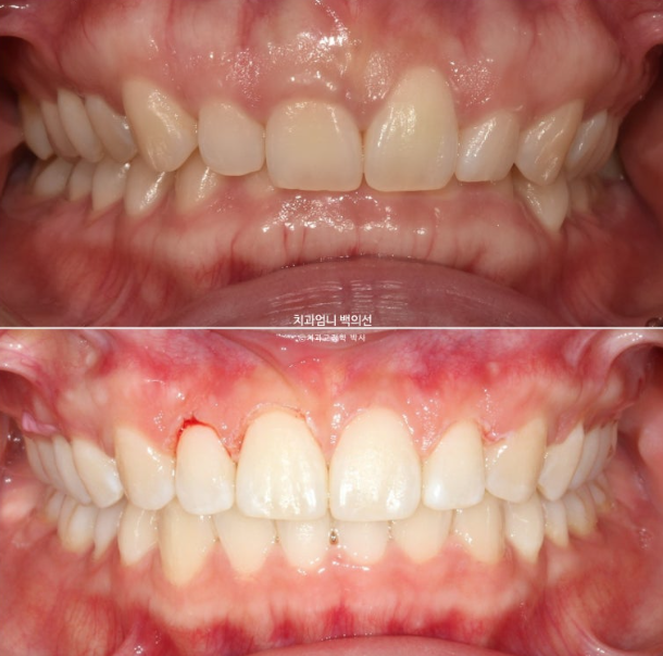 거미스마일 과개교합 교정 잇몸돌출 잇몸 비대칭 관련 이미지 14