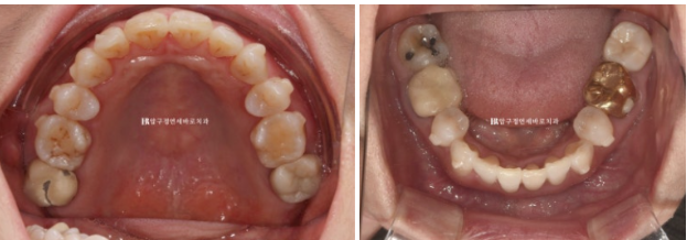 50대 중년교정, 잇몸이 약해도 인비절라인이 가능할까요? 관련 이미지 8