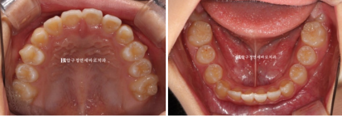 Simultaneous Arch Expansion and Teeth Alignment for Elementary School Children with Invisalign｜Invisalign First image 10