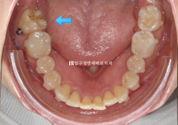 Can Invisalign Lite Work for Patients in Their 40s? A Real Case Improving Scissor Bite and Deep Bite in 10 Months image 10