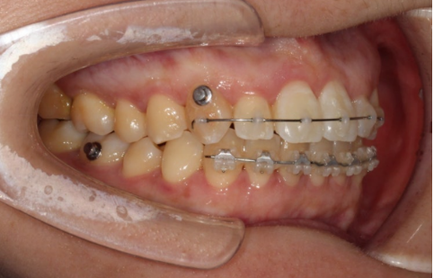 토끼이빨 치아교정 ? 토끼이빨 교정 치료기간은 어떻게 되나요? 관련 이미지 5