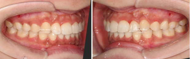 Inward-Tilted Teeth Orthodontic Treatment Review | A Real Case of Treating Congenitally Missing Lower Incisor (Three Lower Front Teeth) Without Extractions image 9