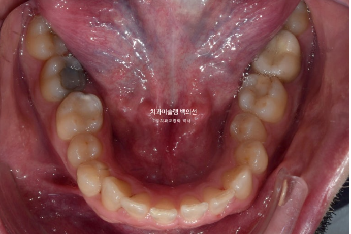 앞니 선천적 결손 인비절라인 임플란트 과개교합 치료 기간 관련 이미지 6