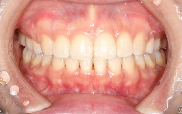 30대 돌출입 발치교정 입술부전증 치료 관련 이미지 9