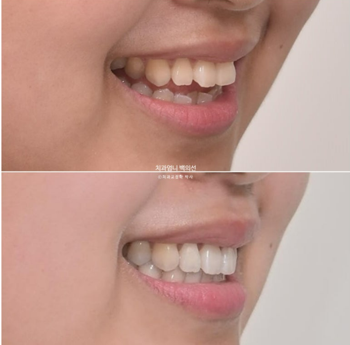 인비절라인 개방교합 교정 어금니 함입 교정 비베라? 관련 이미지 15
