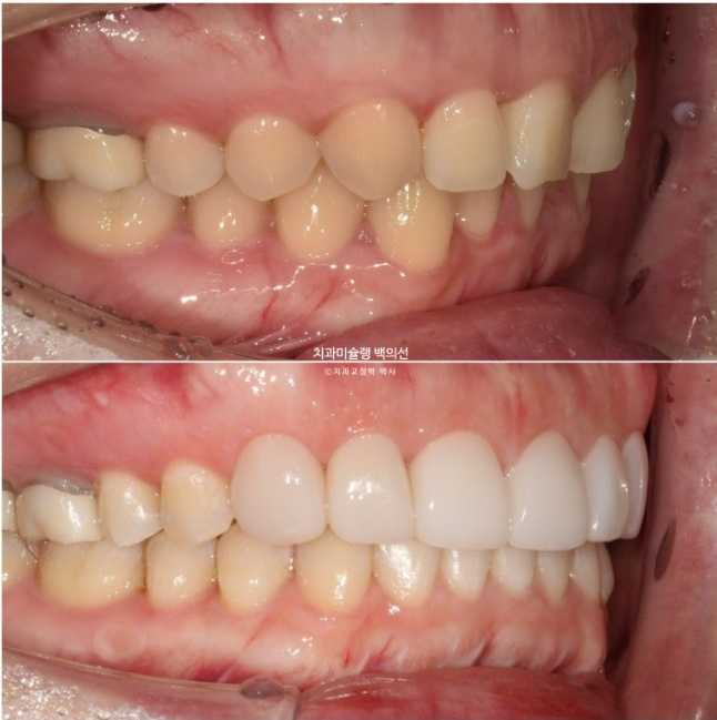 비발치 덧니 교정 인비절라인 과개교합 교정 무삭제 라미네이트 치료 후기 관련 이미지 21