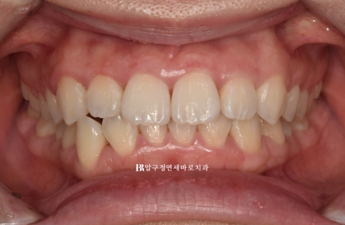 인비절라인 라이트 과개교합 반대교합 돌출입 뻐드렁니 교정 치료 관련 이미지 2