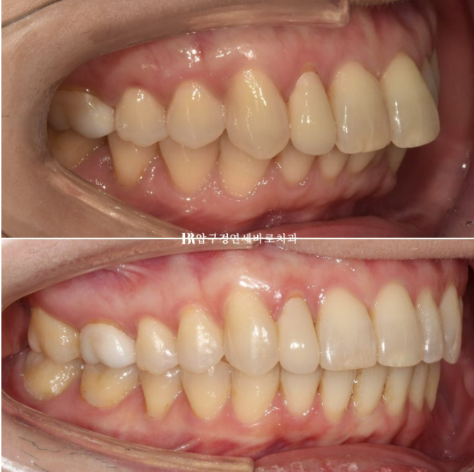 Invisalign Lite for Orthodontic Treatment in Your 40s: Crossbite and Protrusive Mouth Correction image 1