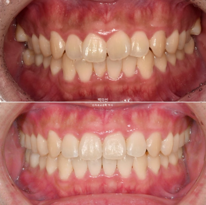 가위교합 나비치아 미니스크류 덧니 교정 인비절라인 라이트 관련 이미지 1