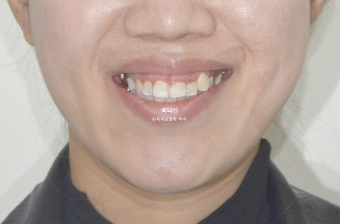 거미스마일 교정 돌출입 발치교정 입술부전 호두턱 치료기간 2년반 관련 이미지 6