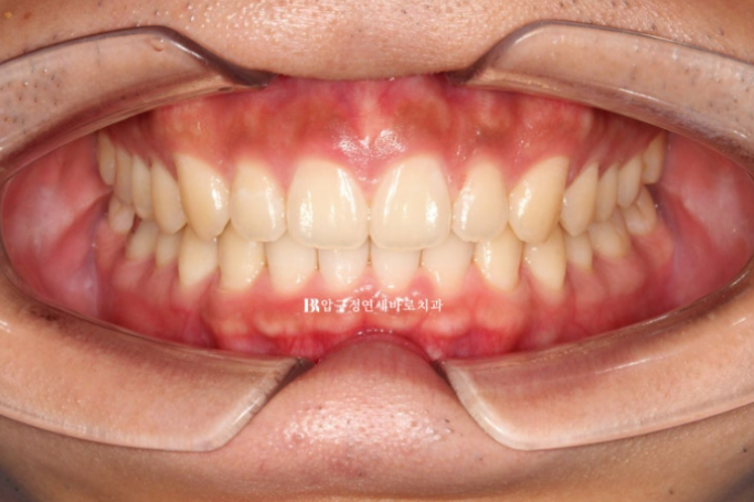 Can Invisalign Fix a Gap Between the Front Teeth? ๐ฎ A Real 9-Month Case Finished Without Remaking Aligners image 6