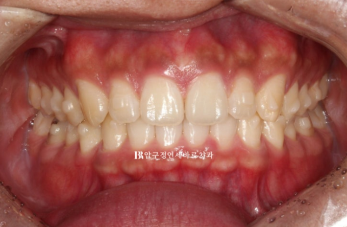 Can Invisalign Fix a Gap Between the Front Teeth? ๐ฎ A Real 9-Month Case Finished Without Remaking Aligners image 5
