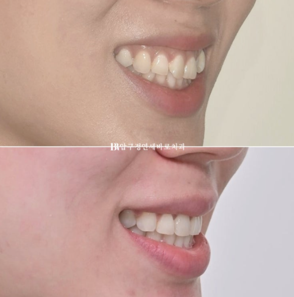 웃을 때 잇몸이 보여요. 잇몸미소 거미스마일 교정하기 관련 이미지 12