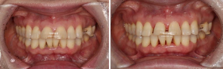50대 치아교정 돌출 치아벌어짐 중년교정 관련 이미지 4