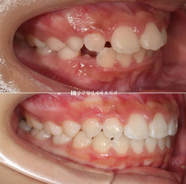 A Child’s Protruding Teeth Correction Review: Difficulty Closing the Lips image 14