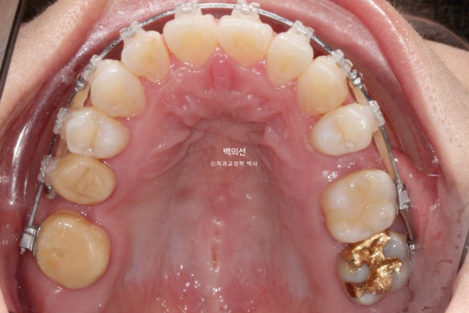 거미스마일 교정 돌출입 발치교정 입술부전 호두턱 치료기간 2년반 관련 이미지 12