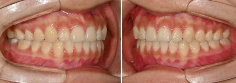유학생 치아교정 해외거주 한국에서 치아교정? 관련 이미지 14