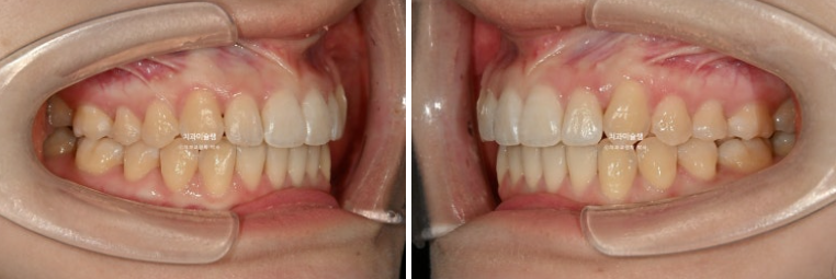 덧니 인비절라인 라이트 잇몸미소 거미스마일 중심선 블랙트라이앵글 관련 이미지 13