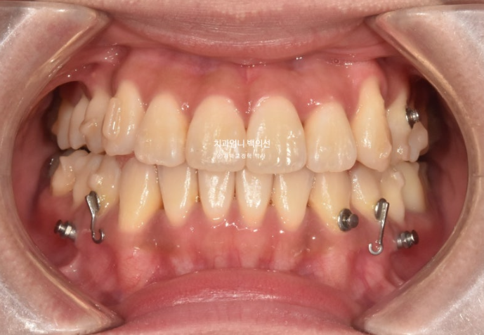 비발치 교정 덧니 인비절라인 교정 절단교합 반대교합 치료기간 1년 6개월 관련 이미지 11
