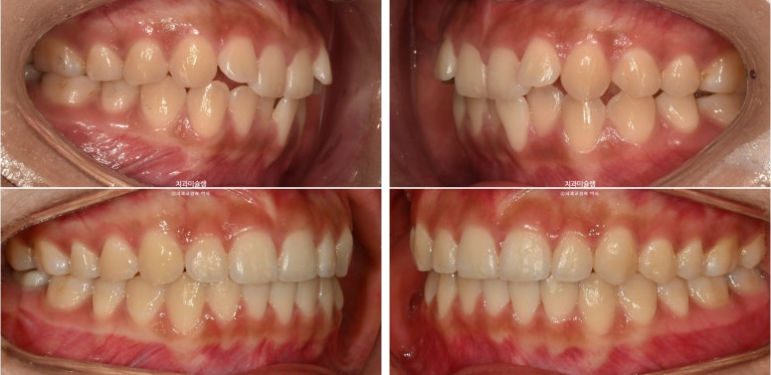 유학생 치아교정 해외거주 한국에서 치아교정? 관련 이미지 18