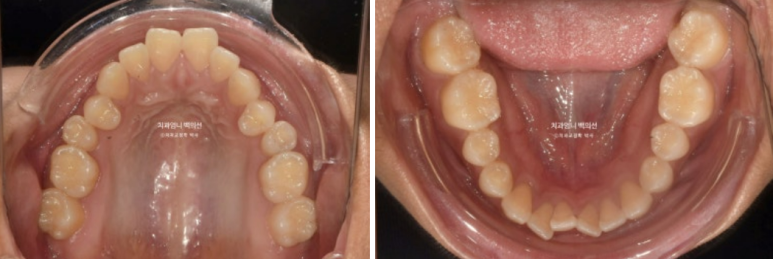 인비절라인 개방교합 교정 어금니 함입 교정 비베라? 관련 이미지 3