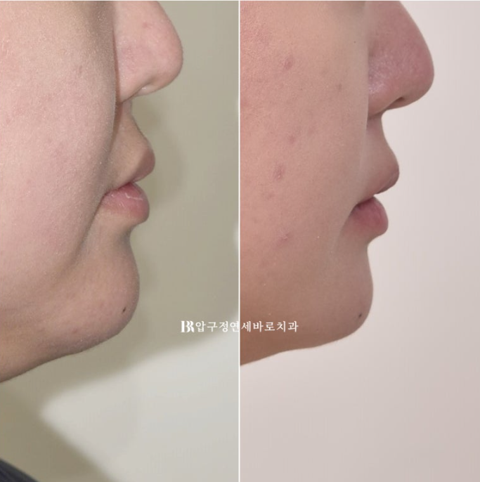 인비절라인라이트 재교정 뻐드렁니 교정 돌출 교정 관련 이미지 10