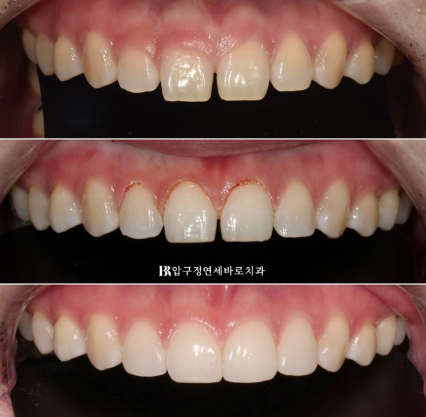 Four No-Prep Veneers for Dwarf Teeth and Conical Front Teeth image 11